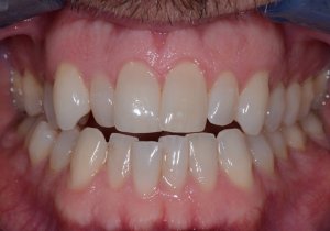 Patient's teeth before Invisalign