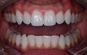 Patient's teeth after Invisalign