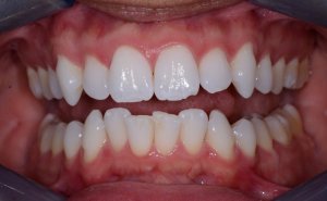 Patient's teeth before Invisalign