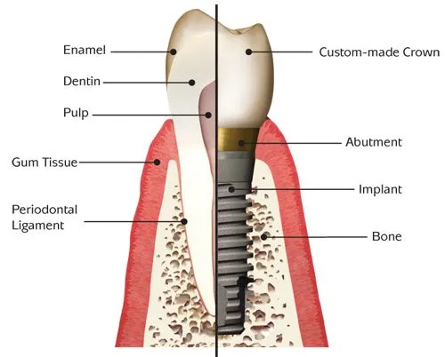 diagram with one half showing anatomy of natural tooth and the other the dental implant parts