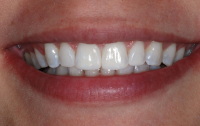 An even, straight smile after Invisalign and bonding.