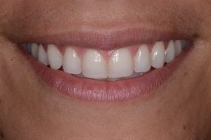 Straight teeth after Invisalign and composite treatment.
