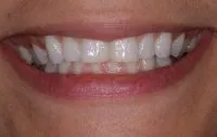 Smile with crooked teeth.