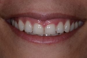 Uneven, gummy smile.