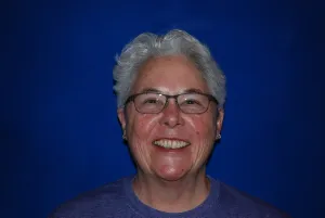 woman with crooked teeth before Invisalign.