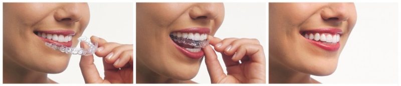 a woman putting on clear aligners