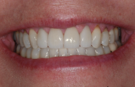 Even, straight smile after Invisalign and veneers.