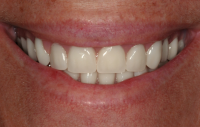 An even smile after dentures.