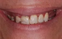 Failing, uneven teeth.