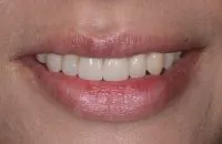 An even, full smile after a dental implant and veneer.