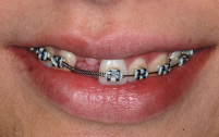Teeth with braces and a gap left by a missing tooth.