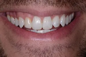 Straight smile after Invisalign.