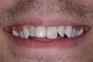 Crooked teeth and uneven smile.