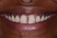 Patient's smile before cosmetic bonding