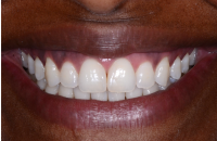 Patient's smile after cosmetic bonding