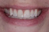 Patient's smile after cosmetic bonding