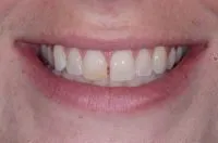 Patient's smile before cosmetic bonding