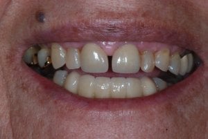 After porcelain crowns