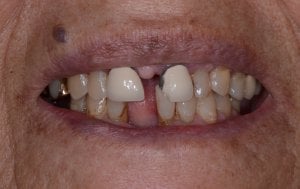Before porcelain crowns