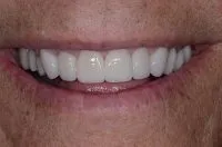 A smile after porcelain veneers
