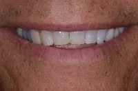 A smile before porcelain veneers