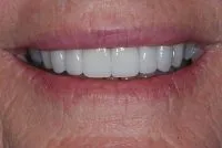 Deteriorating teeth after veneers
