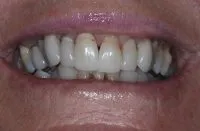 Deteriorating teeth before veneers
