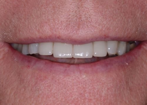 Patient's mouth after dental crowns