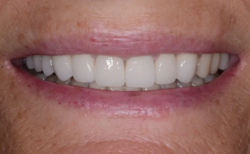 Patient's mouth after dental crowns