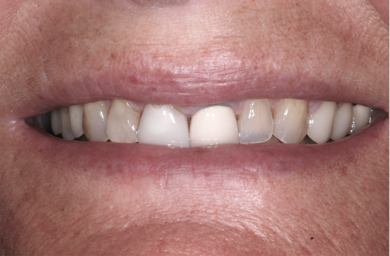 Patient's mouth before dental crowns