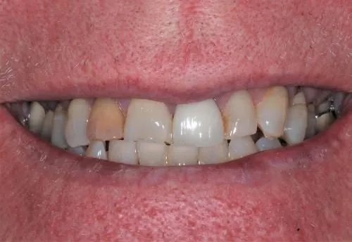 Patient's mouth before dental crowns