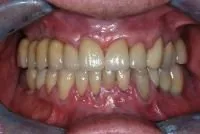 Healthy smile after dental crowns