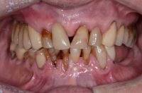 Deteriorating teeth before dental crowns