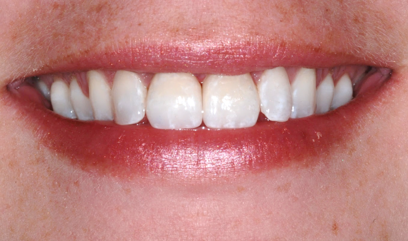 Mouth before after crown