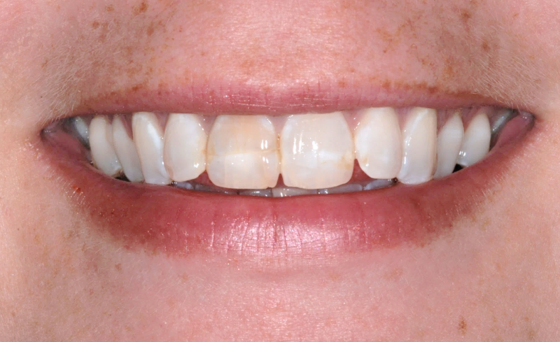 Mouth before dental crown