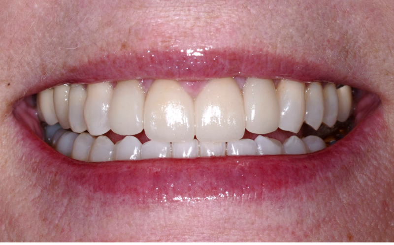 Mouth without a tooth gap after dental crown