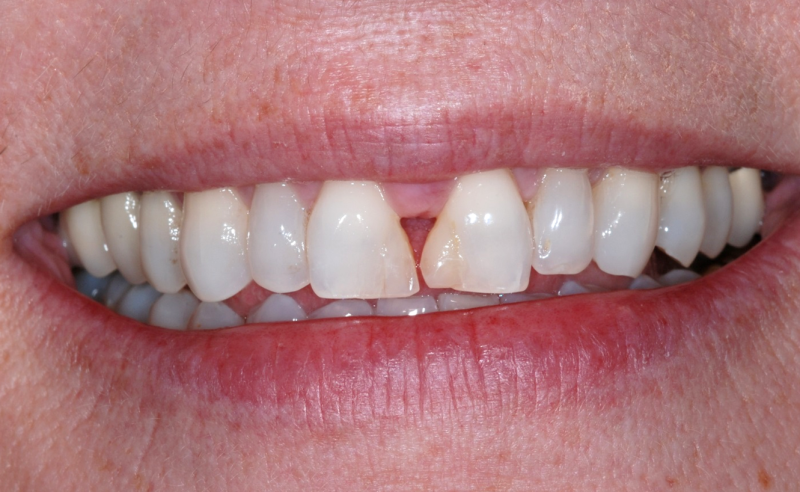 Mouth with a tooth gap before dental crown