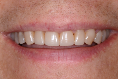 Straight teeth after dental bonding