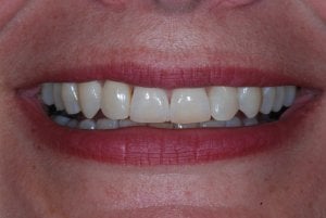 Straight smile before Invisalign
