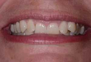 Uneven smile before Invisalign