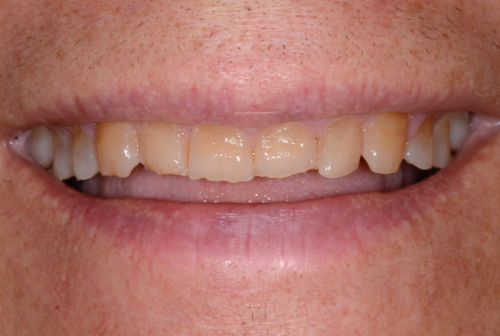 Uneven teeth before dental bonding