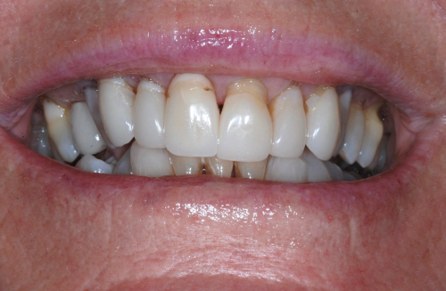 Uneven smile with tooth gap before veneers