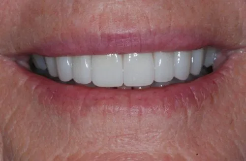 Straight smile after veneers