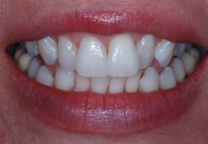 Uneven smile before Invisalign
