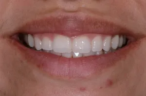Mouth after Invisalign