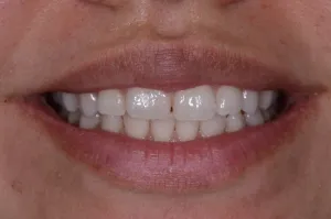 Mouth before Invisalign