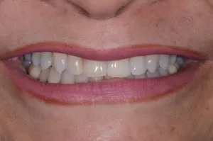 Smile after Invisalign