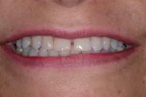Uneven smile with a tooth gap before Invisalign