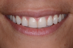 Mouth after Invisalign