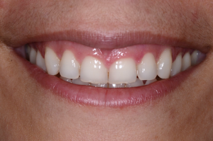 Mouth before Invisalign
